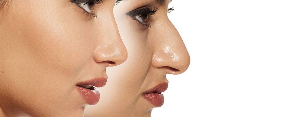 عوارض - عمل بینی - رینوپلاستی - جراحی بینی - تنفس - خون دماغ شدن - دماغ - ورم - پزشکی‌ - تحت معاینه‌ بالینی - داروییِ - تزریق - بیهوشی - نقاهت - کبودی - گروه مَسینا - گروه تخصصی محبوب مجاز